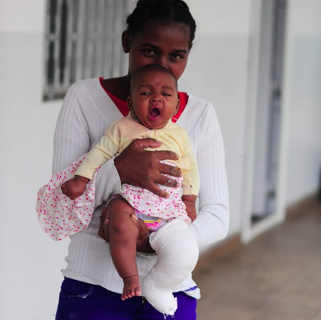Why treating clubfoot results in more than mobility