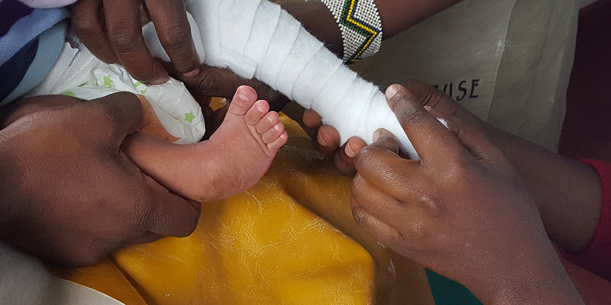 Why Treating Clubfoot Results In More Than Mobility One